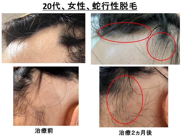 円形脱毛症　病院